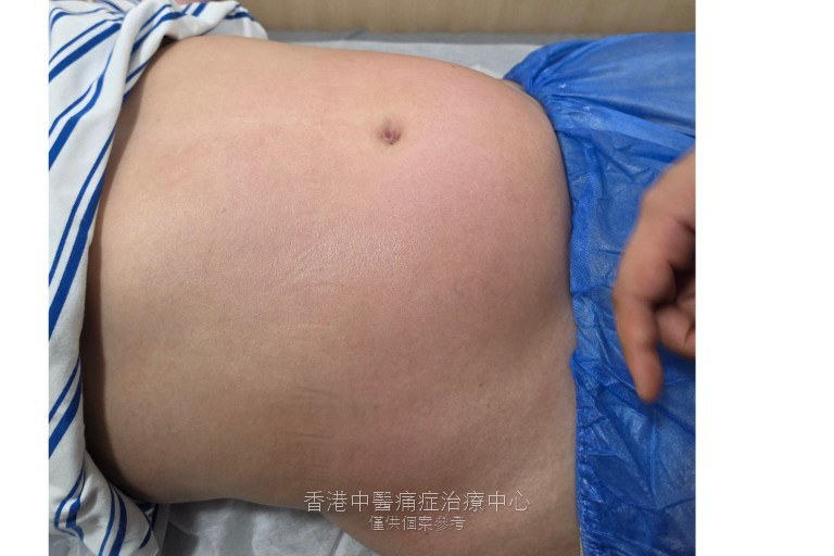 何先生腹部脹感療程前照片