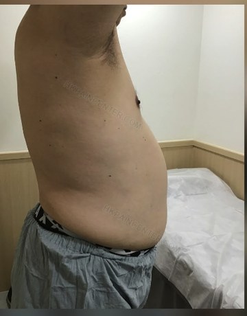 Ben核心熱溫通後腹部外形改善照片