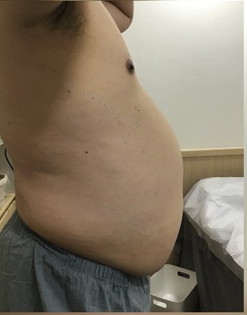 Ben大肚腩療程前側身照片