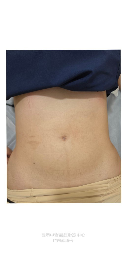林小姐腹部腰線療程前照片