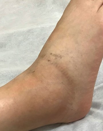 陽太太足踝一次治療後腫脹消退照片