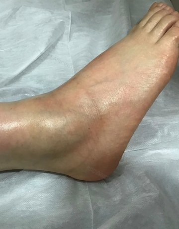 陽太太足踝急性腫脹療程前照片