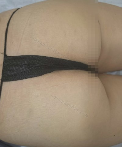 Jessie臀部緊實療程前照片