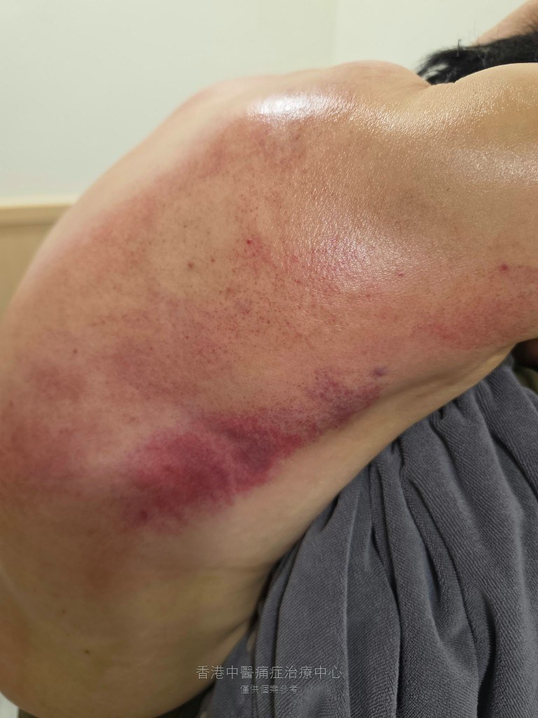 林太太媽媽手治療後腋下結晶痧與肩臂出痧照片