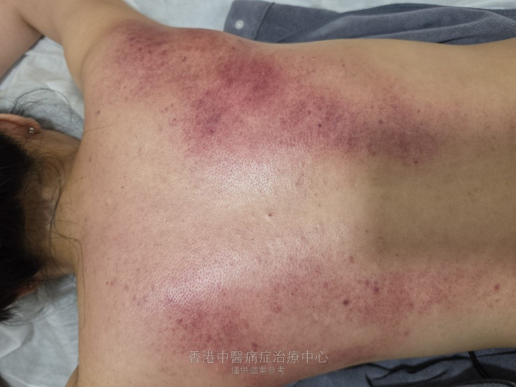 陳太太肩頸勞損治療後上背出痧與鬆解痕跡全景照片