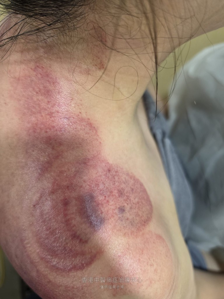 黃小姐低頭使用手機相關肩頸勞損治療後右側肩胛出痧近距照片