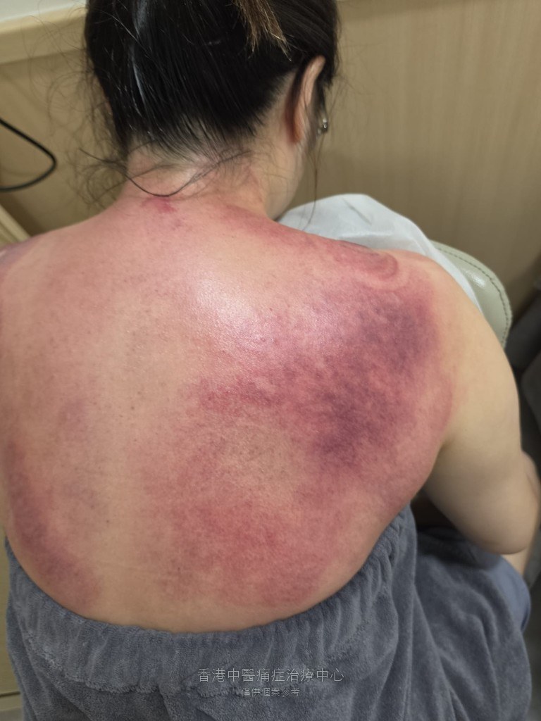 黃小姐低頭使用手機相關肩頸勞損治療後上背與雙肩出痧全景照片