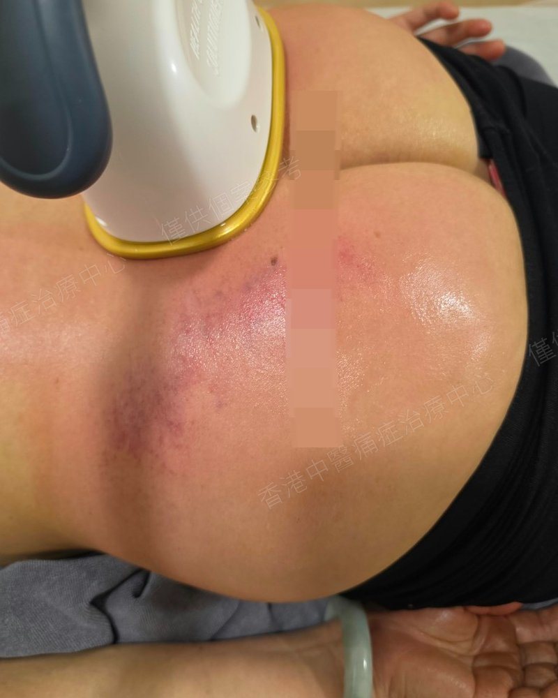 王太太臀腿一帶儀器鬆解治療過程照片