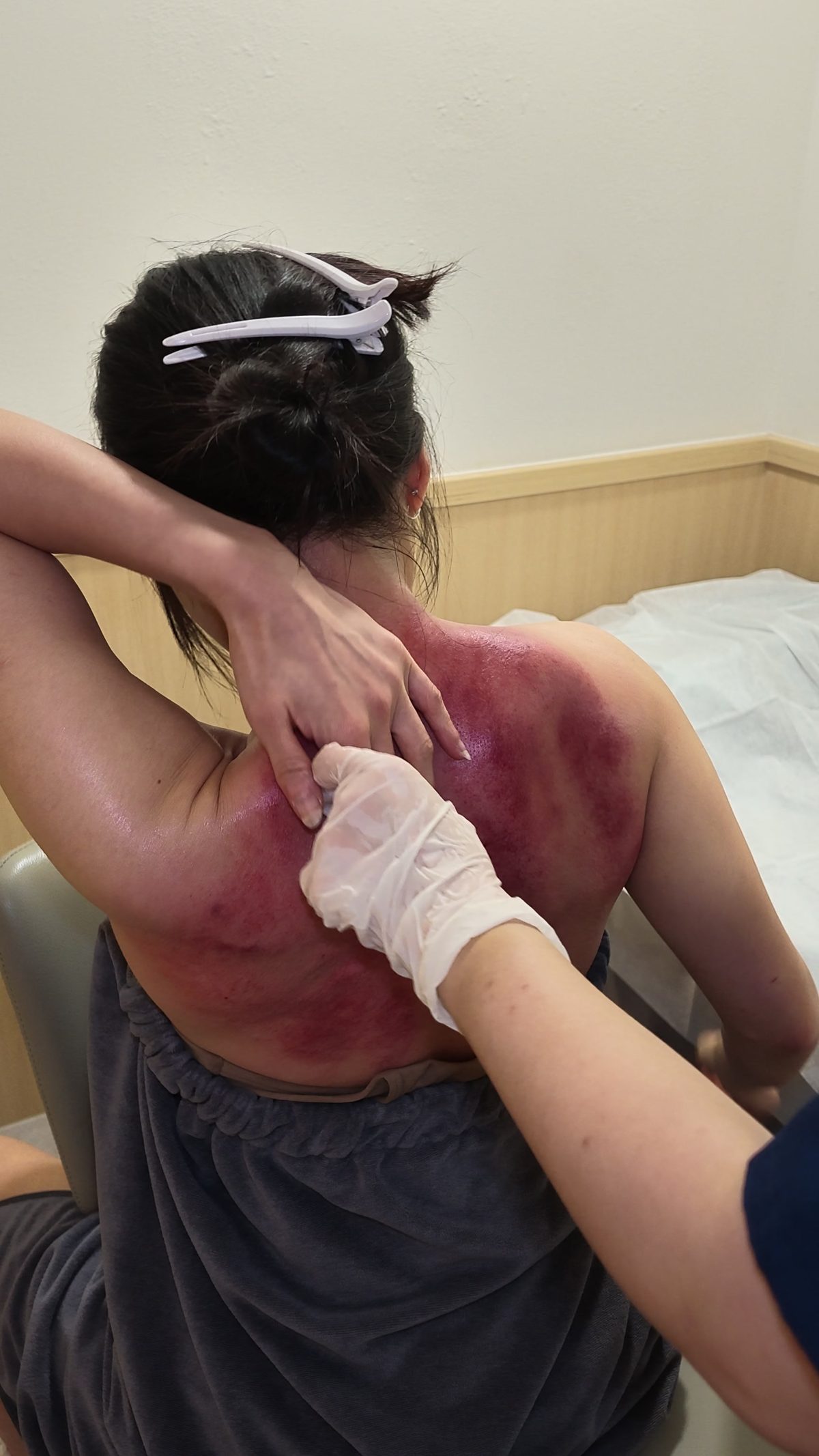診所治療師戴上手套，以手法按壓求診者的肩頸與上背，這是經絡推拿的實際施治畫面。